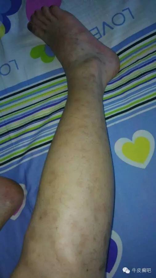 医院专家教你治疗牛皮癣,专家专治牛皮癣方法