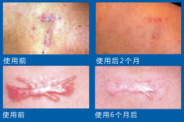 你知道如何挑选祛疤产品吗？三款知名祛疤膏对比