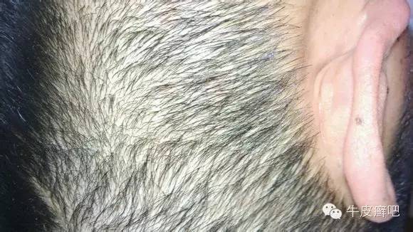 医院专家教你治疗牛皮癣,专家专治牛皮癣方法