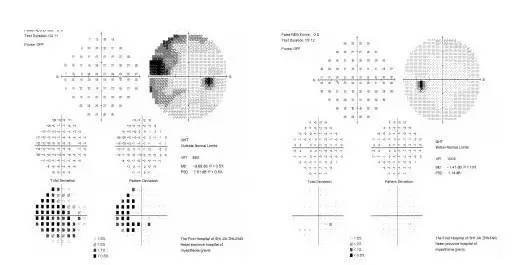 中医治疗正常眼压开角型青光眼,原发性闭角型青光眼快速降眼压