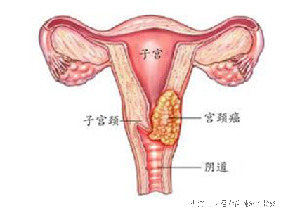 预约宫颈癌疫苗是怎么预约,关于宫颈癌疫苗的知识文章