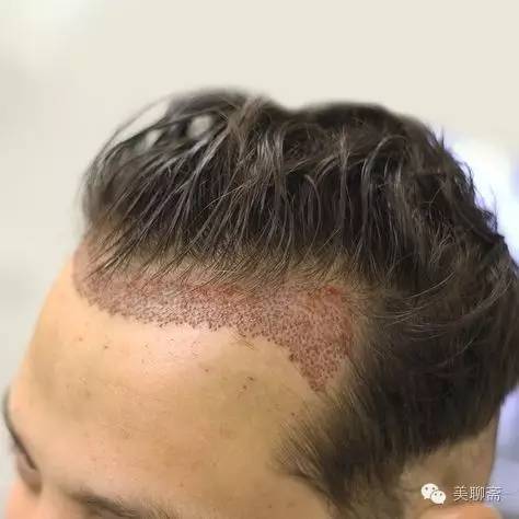 植发际线的亲身体验,亲身体验植发经历