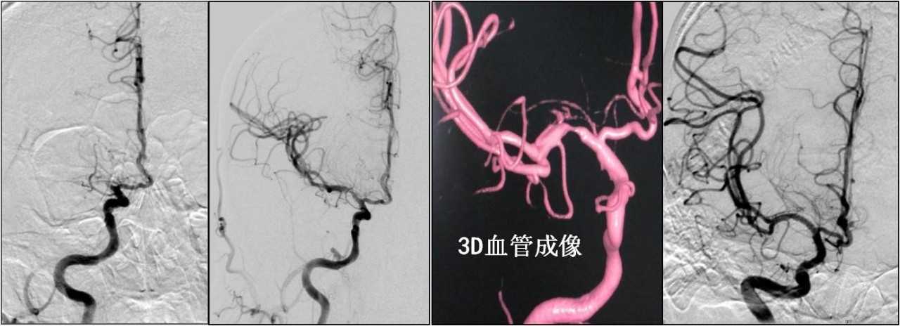 介入医学手术类视频,颈动脉介入手术病例分享