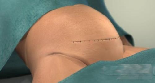 剖腹产女人不可逆的伤害,剖腹产请善待妈妈