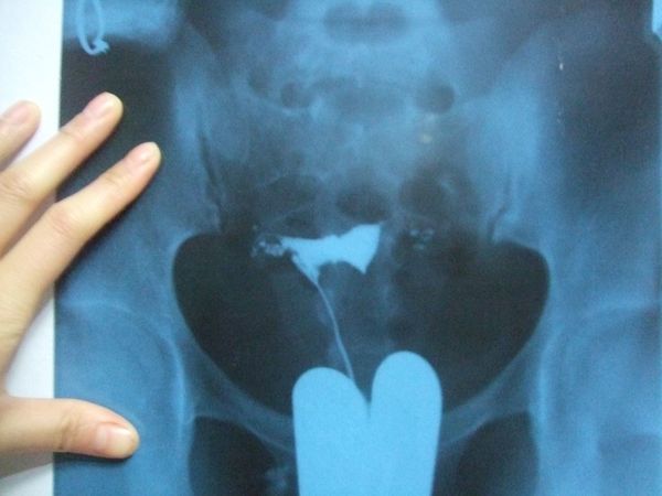 什么情况下输卵管需要造影,刚做了输卵管通水多久可以做造影