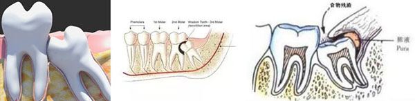 智齿发炎烦恼,智齿含牙囊肿需要尽早拔除吗