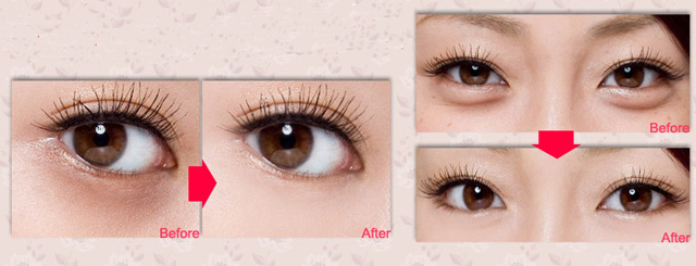 1分钟快速消除黑眼圈眼袋,1分钟教你快速遮黑眼圈