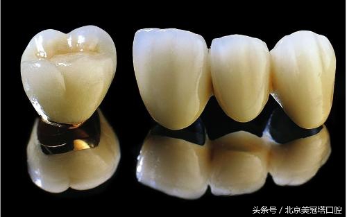 到底应不应该做烤瓷牙,来自医生的忠告不要随便做烤瓷牙