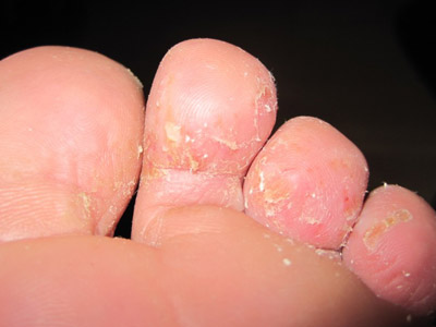 脚气让我痒的不行!还好有这些百年难得一遇的小偏方!