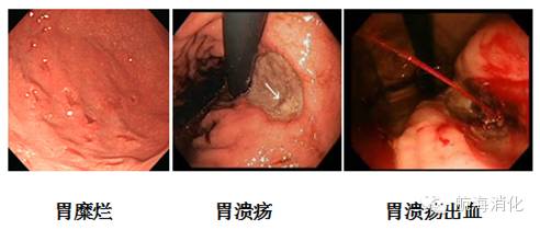 阿司匹林氯吡格雷肠道出血,阿司匹林和氯吡格雷伤胃怎么办