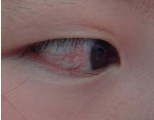 有那种除眼睛血丝的眼药水吗,眼睛有血丝发黄浑浊用什么眼药水