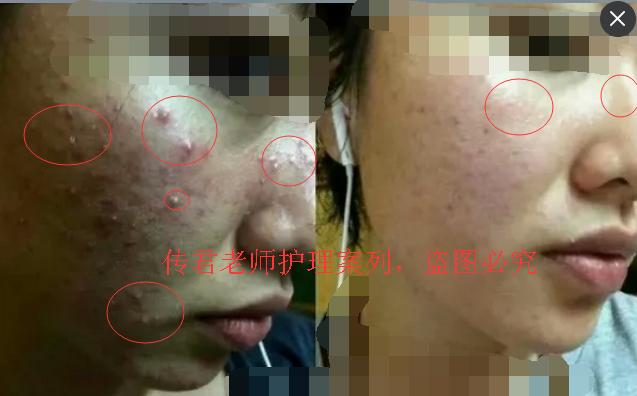 痘痘反复怎么改善？找出根本原因祛除痘痘防复发