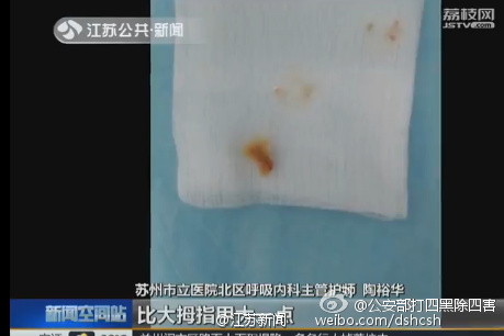 苏州老伯反复咳嗽竟因蟹壳卡喉6年！