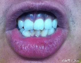 牙龈变色暗示哪里有病,牙龈变黑是什么征兆