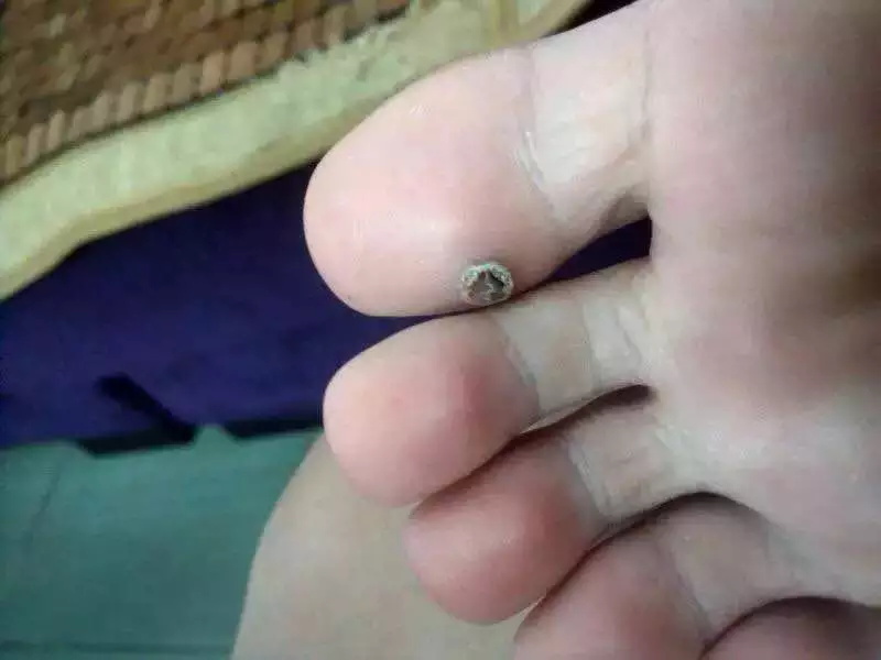 鸡眼病因,鸡眼发病原因与中医治疗