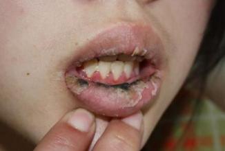 嘴唇干裂，越干越想舔，越舔越干躁结痂，这是咋哩？