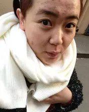 常年长痘的皮肤怎么调理回来,经常长痘如何快速消除