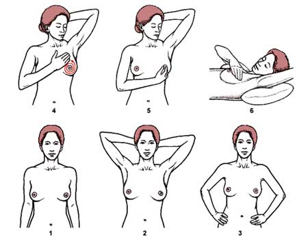 乳腺癌早期一般有6大征兆,乳腺癌早期十大的症状是什么