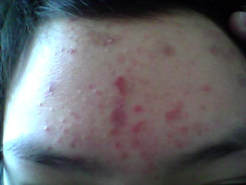 痘痘反反复复长的原因和应对方法,发际线两边痘痘反反复复一直冒痘