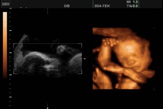 怀孕几个月做四维彩超比较合适,怀孕几个月能做四维图片