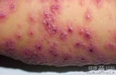 湿疹性皮炎中医辨证,小儿湿疹中医辨证