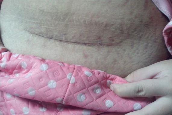 院长剖腹产,剖腹产后医生必做的几件事