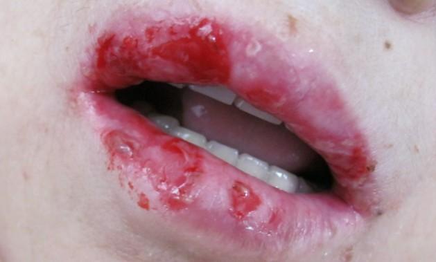 嘴上长泡长疱疹瘙痒怎么办注意这几点。。。