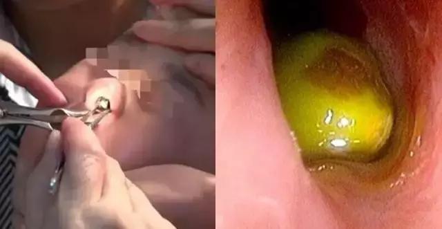 西安：男童游乐园遭意外三粒决明子进入耳中