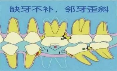 蛀牙怎么才能清洗干净牙科,自己怎么清理牙上的蛀牙