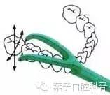 蛀牙怎么才能清洗干净牙科,自己怎么清理牙上的蛀牙