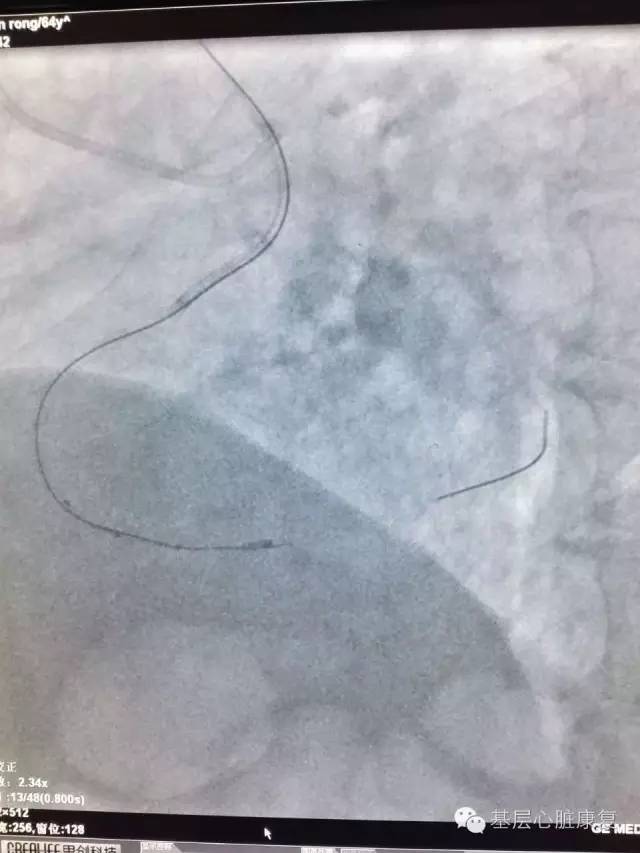 攻克冠心病,治疗冠心病的高科技