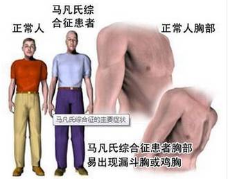 手长脚长似“蜘蛛人”，肇东一姐弟26岁“准时”发病，基因来自35岁去世的妈妈