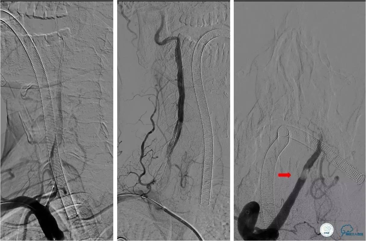 后循环系统梗死,后循环梗死
