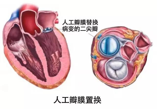 干货丨“心脏阀门”二尖瓣出故障了怎么办？