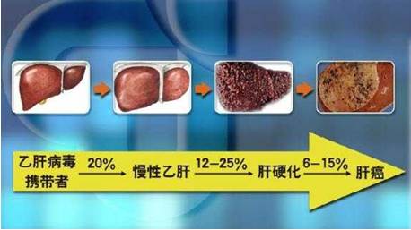 肝癌晚期食疗法,中医对晚期肝癌有何调养处方