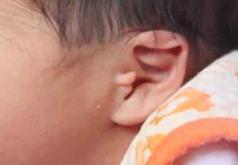 宝宝长了附耳有必要切除吗,宝宝长附耳是男方还是女方的原因