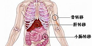 直肠癌肺转移和扩散有区别吗,直肠癌切肛手术后还能扩散转移吗