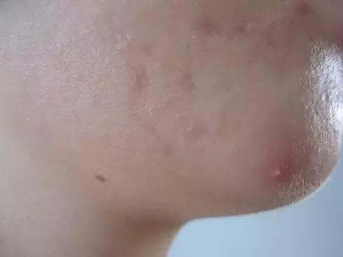 脸上起了好多红色的小痘痘摸着痛,脸上痘痘好了有红色疙瘩不痛不痒