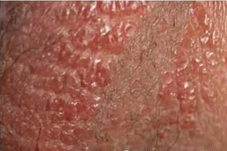 得了湿疹怎么办？日常注意就可以避免