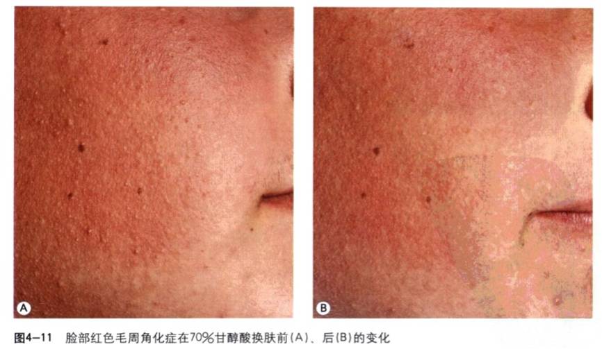 果酸换肤方法,果酸换肤让皮肤焕然一新