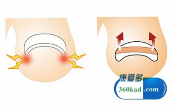 趾甲太短变甲沟炎怎么治疗,甲沟炎剪的太短也会发作吗