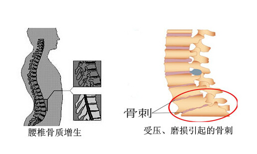 腰椎间盘骨质增生缓解疼痛的运动,吃芬必得能缓解腰椎骨质增生吗