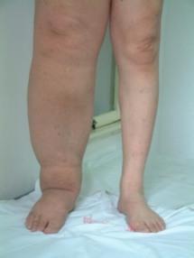 九旬老汉每天“挤奶”4斤，什么是淋巴？