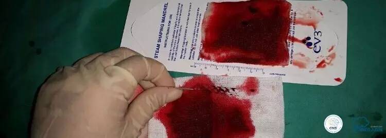 下肢血栓微创介入治疗的费用,急性深静脉血栓形成的诊断和治疗