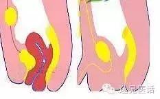 脐部感染流脓,脐部渗血的原因及护理