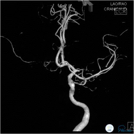 大脑左侧中动脉是主动脉吗,什么是左侧大脑中动脉代偿供血
