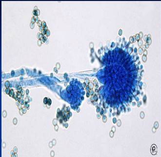 痰中有真菌，就一定要抗真菌治疗？