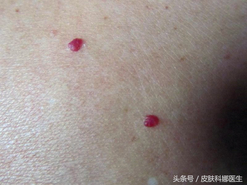 长鲜红斑痣民间中医能治吗,皮肤上像红痣的红疙瘩可以刺破吗