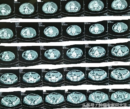 恶心呕吐没当回事，半年后被诊断为胃癌晚期