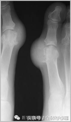 软组织钙化与骨化,软组织钙化和骨质增生